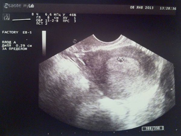 15 3 недели беременности